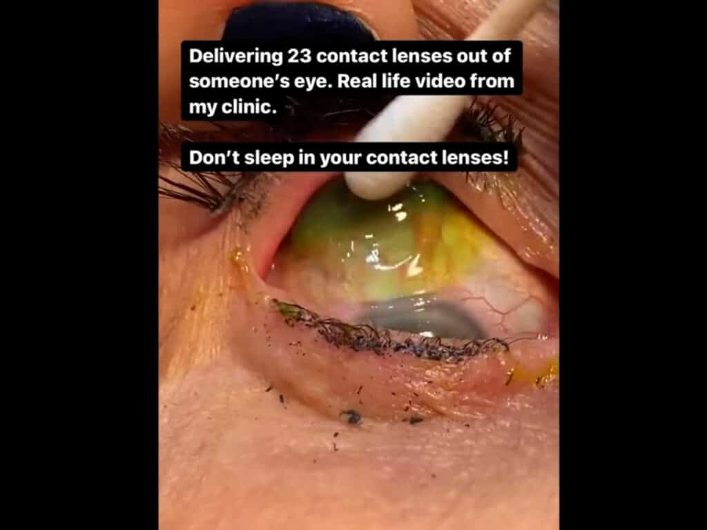 Lääkäri poisti 23 piilolinssiä potilaan silmästä