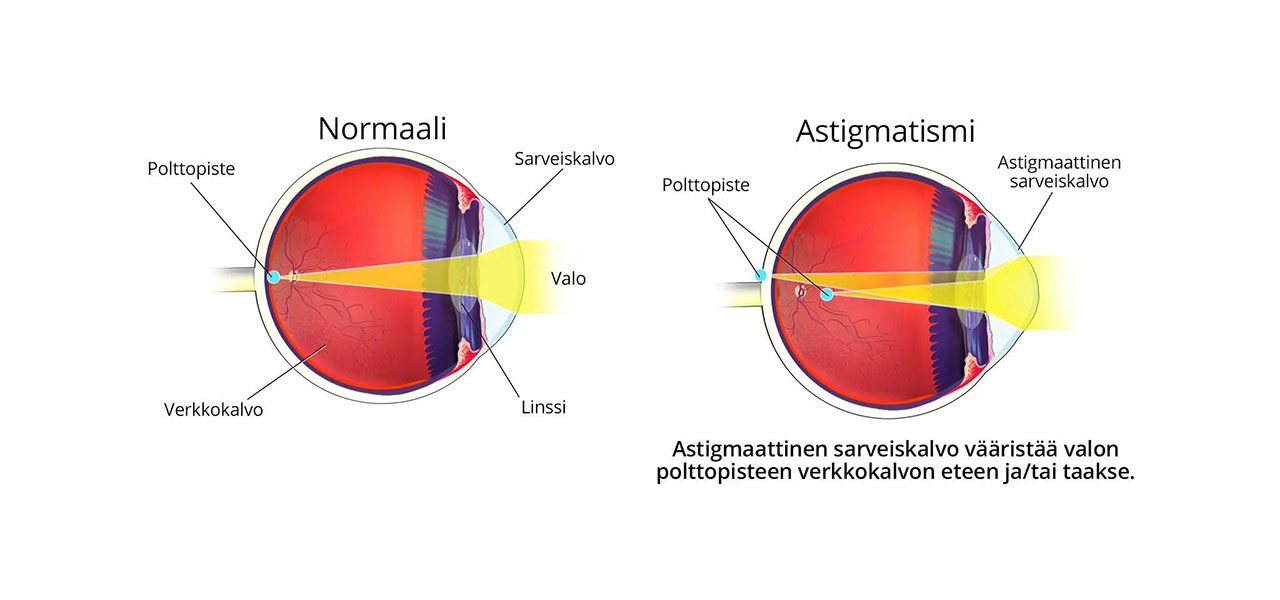 Hajataitto eli astigmatismi on hyvin yleinen, sarveiskalvon epätasaisuudesta johtuva taittovirhe, jota voidaan korjata toorisilla piilolinsseillä.