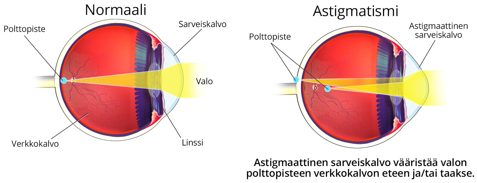 Hajataittoa eli astigmatismia voidaan korjata toorisilla piilolinsseillä.