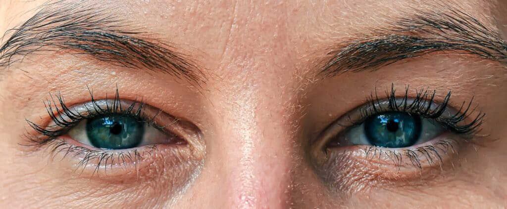 Kuivat silmät eli kuivasilmäisyys piilolinssien käytössä