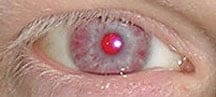 Punainen silmien väri albinolla. Kuva: Karen Grønskov, Jakob Ek ja Karen Brondum-Nielsen, Wikimedia Commons